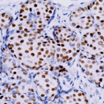 Imagen: Análisis inmunohistoquímico de un tejido de carcinoma  de mama utilizando un anticuerpo monoclonal anti-receptor de estrógenos, que busca ayudar a predecir la recurrencia del cáncer de mama (Fotografía cortesía de Thermo Fisher Scientific).